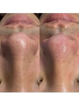 ニューフェイス(NEW FACE)/毛穴洗浄