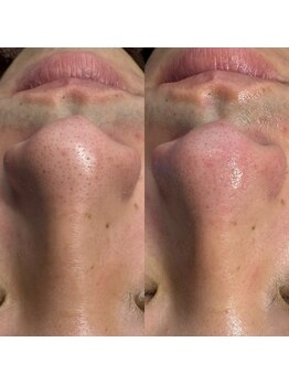 ニューフェイス(NEW FACE)/毛穴洗浄