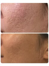 ハクビューティー(HAKU BEAUTY)/凹凸ケアは難しい？