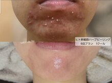 サロンドリー(salon de Re)/肌質改善☆3ヵ月の変化