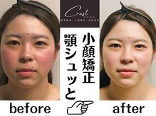 クレスト(CREST)/ビフォーアフター【小顔名古屋】