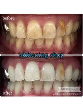 ホワイトニングショップ 桜木町店/【詰め物や差し歯がある方】