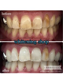 ホワイトニングショップ 桜木町店/【詰め物や差し歯がある方】