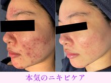 オーシャンブルー 大分店(OCEAN BLUE)/本気のニキビケア