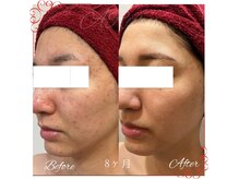 アルルプラス 南草津(ARuru+)の雰囲気（ニキビ、毛穴改善　ノーファンデーションに導く肌改善プログラム）