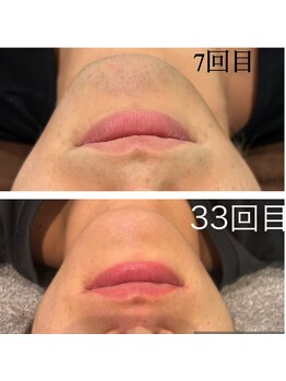 レイモード(Ray mode)/ヒゲ脱毛爆抜け