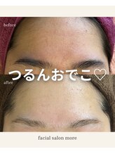 ヨサ モア(yosa more)/【10代額ごわつき】BeforeAfter