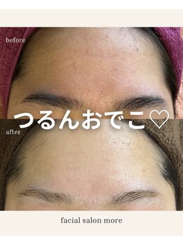 ヨサ モア(yosa more)/【10代額ごわつき】BeforeAfter