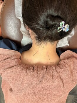 ピース鍼灸整骨院の写真/心地よく痛みが少ない鍼で身体の不調にアプローチ! 慢性的な首肩こりや腰のつらさでお悩みの方にオススメ♪