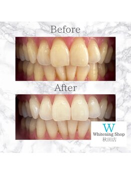 ホワイトニングショップ 秋田店/【before after】 美白