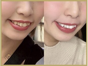 ライトケアサロン 銀座店(Light Care Salon)/セルフホワイトニングの症例写真