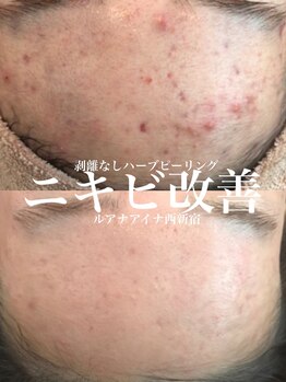 ルアナアイナ(Luana Aina)/ハーブピーリングでニキビケア