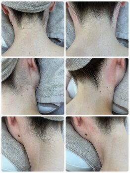 フォルトゥーナ ビューティー(Fortuna Beauty)/ブライダルシェービング