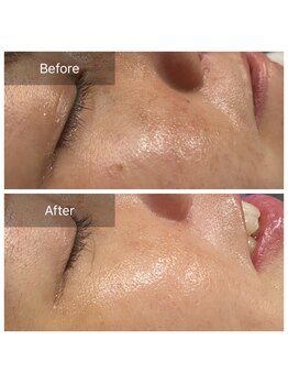 アヴニール 光の森(AVENIR)/毛穴洗浄１回の効果☆