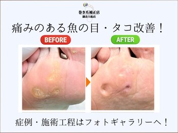 巻き爪補正店 鎌倉大船店の写真/プロの技で硬い角質を取り除き、なめらかな足裏と美爪に[トータル足裏角質ケア＋足の爪切りセット￥8250]