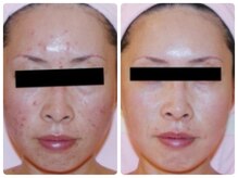 スイ 昭島店(Sui)/ホワイトスノーピール/シミ/美白