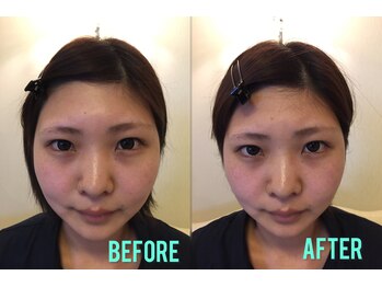 エムドゥービー(Mde`B)/小顔矯正。キュアフェイス