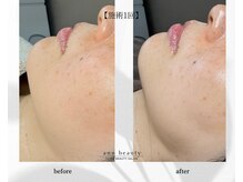 アン ビューティー(ann beauty)/施術1回【症例写真】