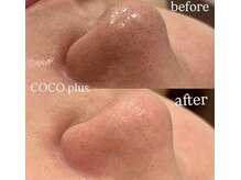 ココプラス(COCO plus.)の雰囲気（各韓国肌管理メニュー、ハイドラ、毛穴洗浄水光肌♪【毛穴】）