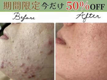 アリュール 倉敷(ALLURE)の写真/【7月限定50%OFF】肌に優しいハーブで癒されながら肌質改善◇皮膚科でもダメだった長年のお悩みに◎