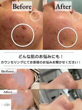 毛穴ラボ 梅田(毛穴LABO)&nbsp;肌のお悩み 全て改善