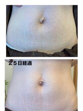 エミニナル(emininal)/フォースカッタークリーム経過