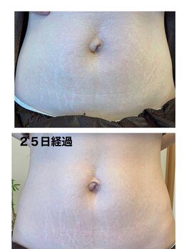 エミニナル(emininal)/フォースカッタークリーム経過