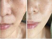 キュアフロウ 橿原店/4回来店☆たるみ特化ケア