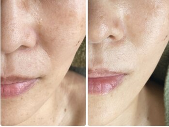 キュアフロウ 橿原店/4回来店☆たるみ特化ケア