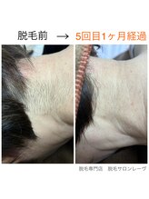 レーヴ/うなじ脱毛・襟足脱毛☆