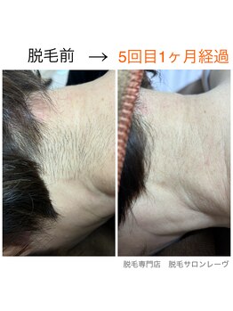 レーヴ/うなじ脱毛・襟足脱毛☆