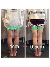 クシロ鍼灸整骨院/【O脚矯正】施術例