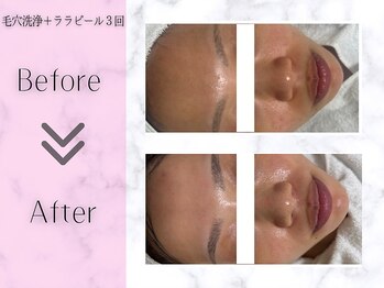 リライフ(ReLIFE)/韓国肌管理/毛穴洗浄+ララピール