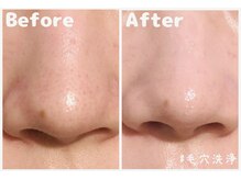 シャルム 大崎古川店(Charme)の雰囲気（ハイドラ毛穴洗浄で奥深くの汚れを一掃！！トーンアップが叶う♪）