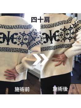 からだサロン サニー 堺東(SUNNY)/肩の痛み