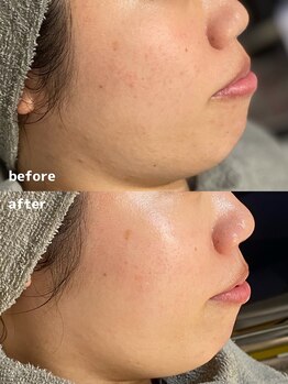 ラエッセ 恵比寿(LAESSE)/【ニキビ・肌荒れ跡改善】