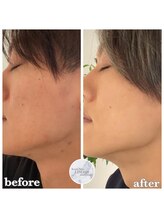 リノア 心斎橋店(LINOAH)/光フェイシャル　b → a