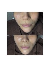 マリーメリー(marie merry)/肌質改善