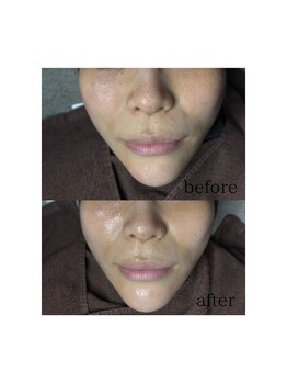 マリーメリー(marie merry)/肌質改善