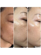 ビースキン(be-skin)/シミケアbefore→after