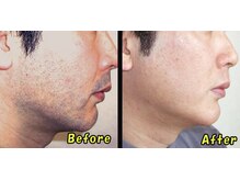 こふこふ/ひげの施術