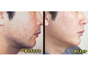 こふこふ/ひげの施術