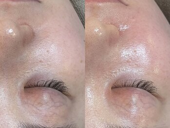 ビーマジック(Be Magic)/毛穴/毛穴洗浄/小顔/眉毛