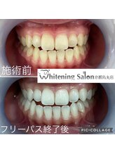 ホワイトニングサロン 京都烏丸店/ホワイトニング施術例