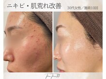 スリースリー 恵比寿(THREE THREE)/ニキビ・肌荒れケア
