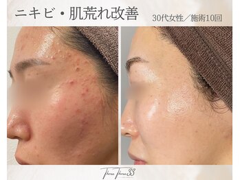 スリースリー 恵比寿(THREE THREE)/ニキビ・肌荒れケア