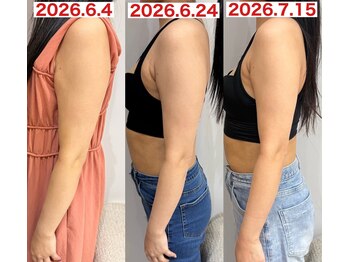 サロンノコ(salon NOKO)の写真/【効果抜群◎】<ドレス映えするボディに>韓国で人気の美容液レッドショット導入店◎ダイエット/痩身