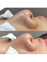 ビビ(Be_bi)/徹底毛穴洗浄