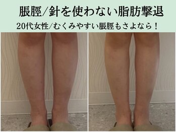 ソルニス(Solnis.)/痩身☆脂肪分解/ハイパーナイフ