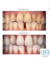 アース 福岡天神店(EARTH)/before　after　【美白】